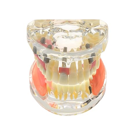 Teeth Model Kit Dental Implant Typodont Restoration 7 Implants Bridge Inferior Upper+Lower Treatment Demo for Study Teach