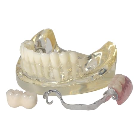 Dental Typodont Model with Implants and Partial Denture, Demonstration for Dental Teaching, Study and Demonstration - Professional Oral Care Model